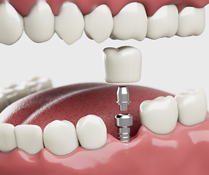 üsküdar-implant-tedavisi-klinikzade