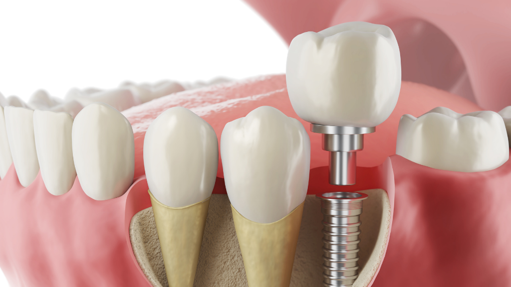 üsküdar-implant-tedavisi-klinikzade